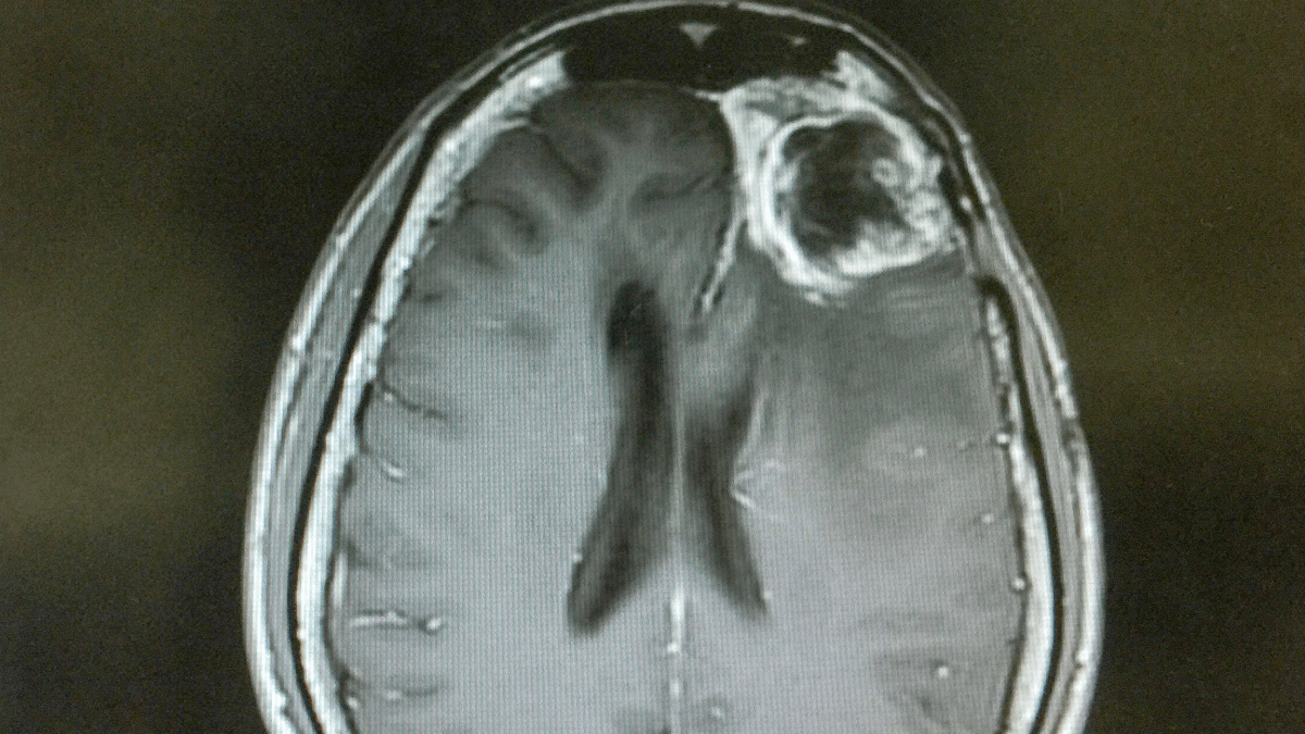 la vacuna SurVaxM se muestra prometedora para retrasar el regreso del glioblastoma