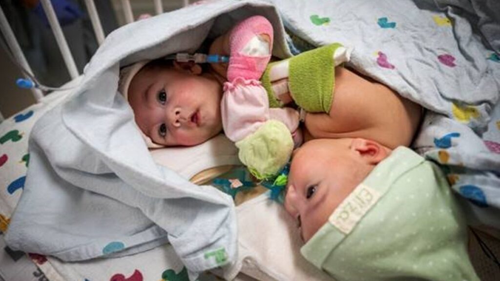 Siamesas separadas en hospital de Texas regresan a casa