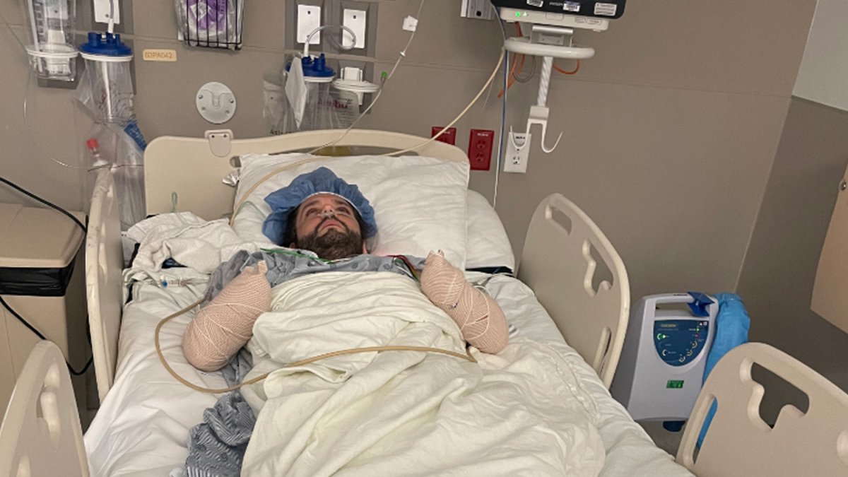 qué se sabe del hombre amputado tras picadura de pulga