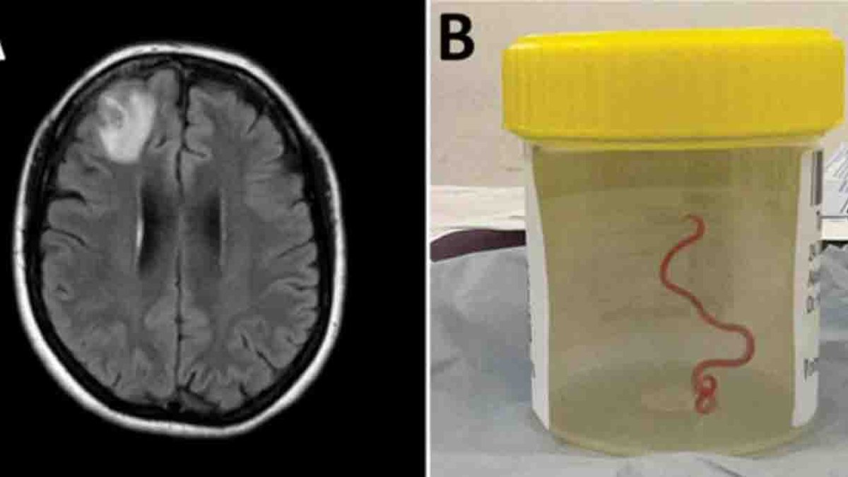 Le extraen del cerebro una lombriz intestinal viva, común en serpientes pitones