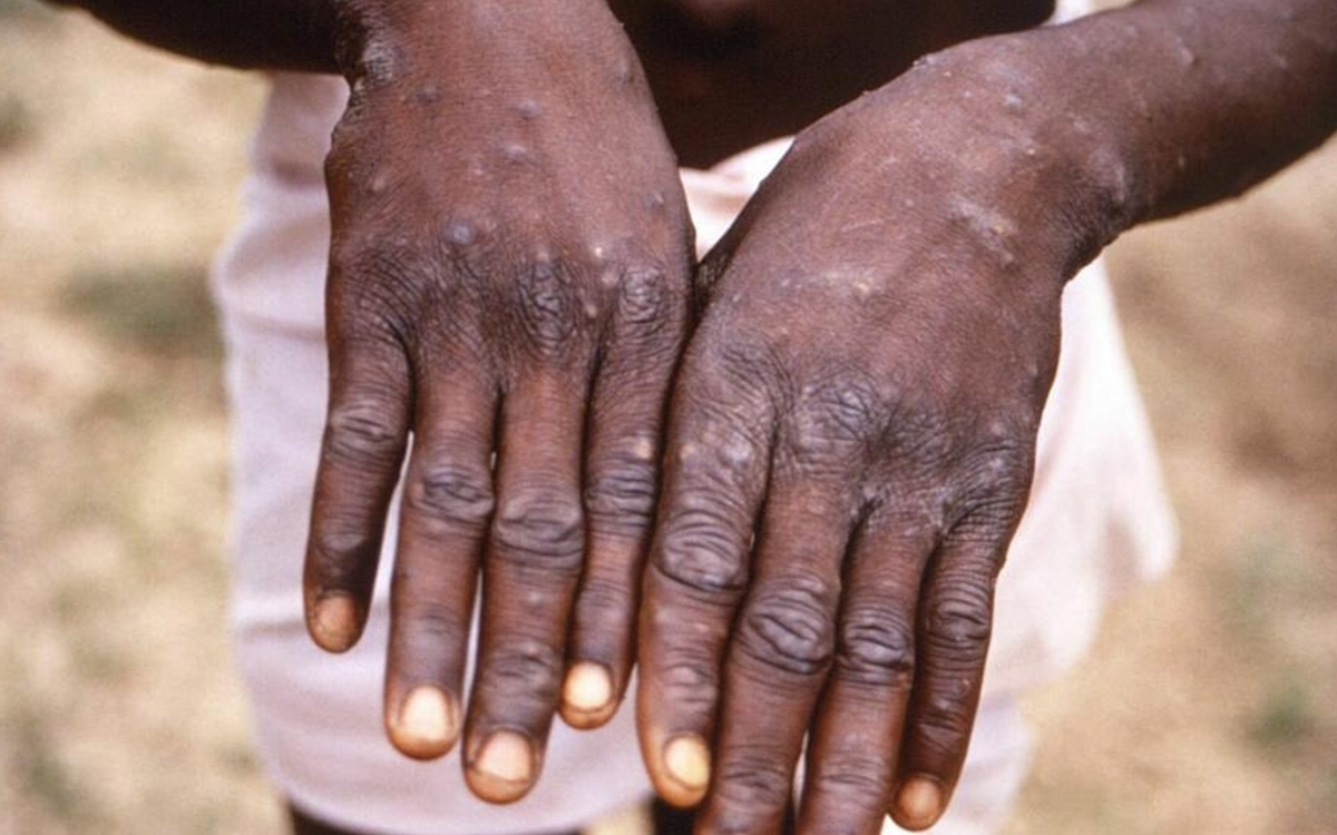 ¿Hay rebrote de la viruela del mono en África?