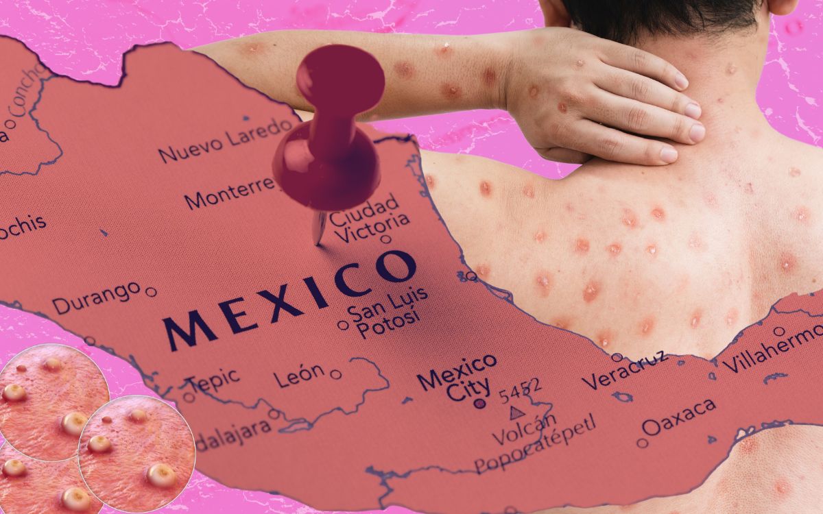 Alertan por caso de mpox en México; festival de Zipolite, posible punto de infección