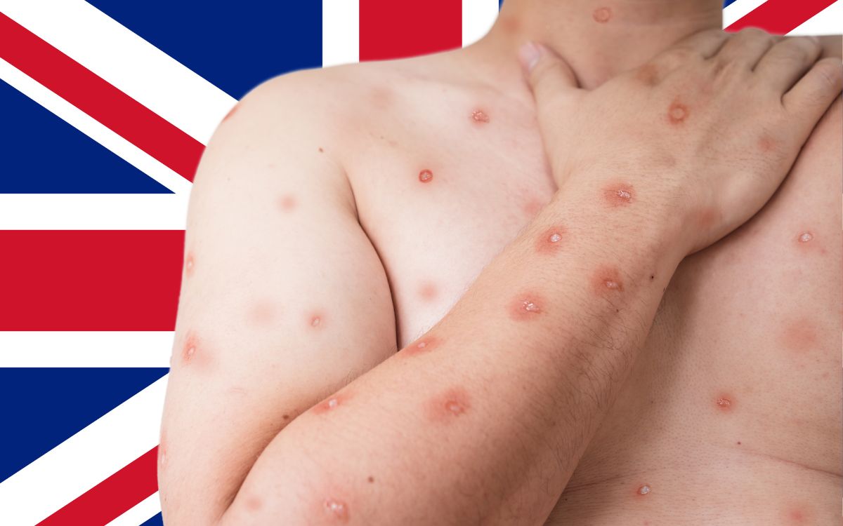 Reino Unido detecta primer caso de la nueva variante de mpox