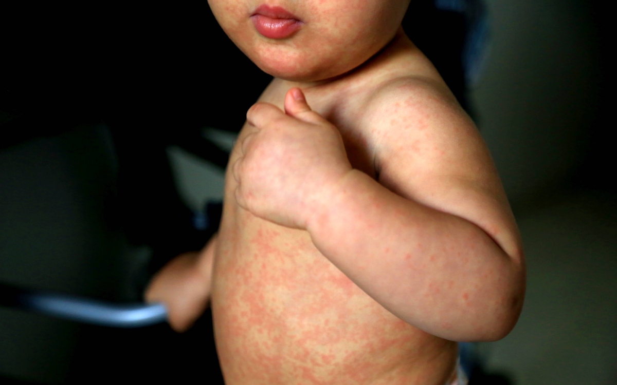 Plan de Florida contra las vacunas abre la puerta al sarampión en EE.UU., según estudios