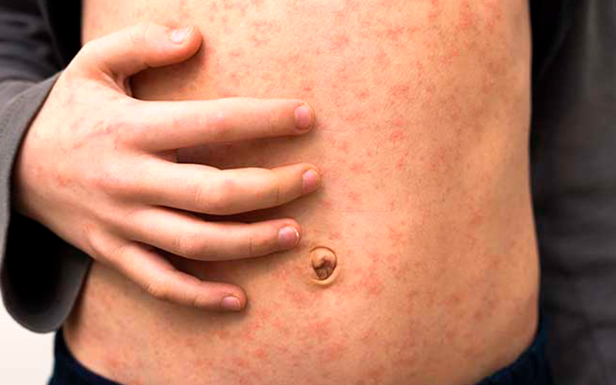 México encabeza muertes por sarampión en América y es segundo en contagios: Informe de la OPS